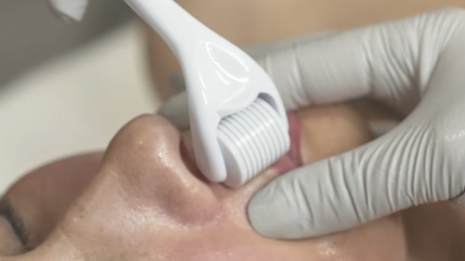 A Professional’s Guide to Choosing the Right Microneedling Kit
