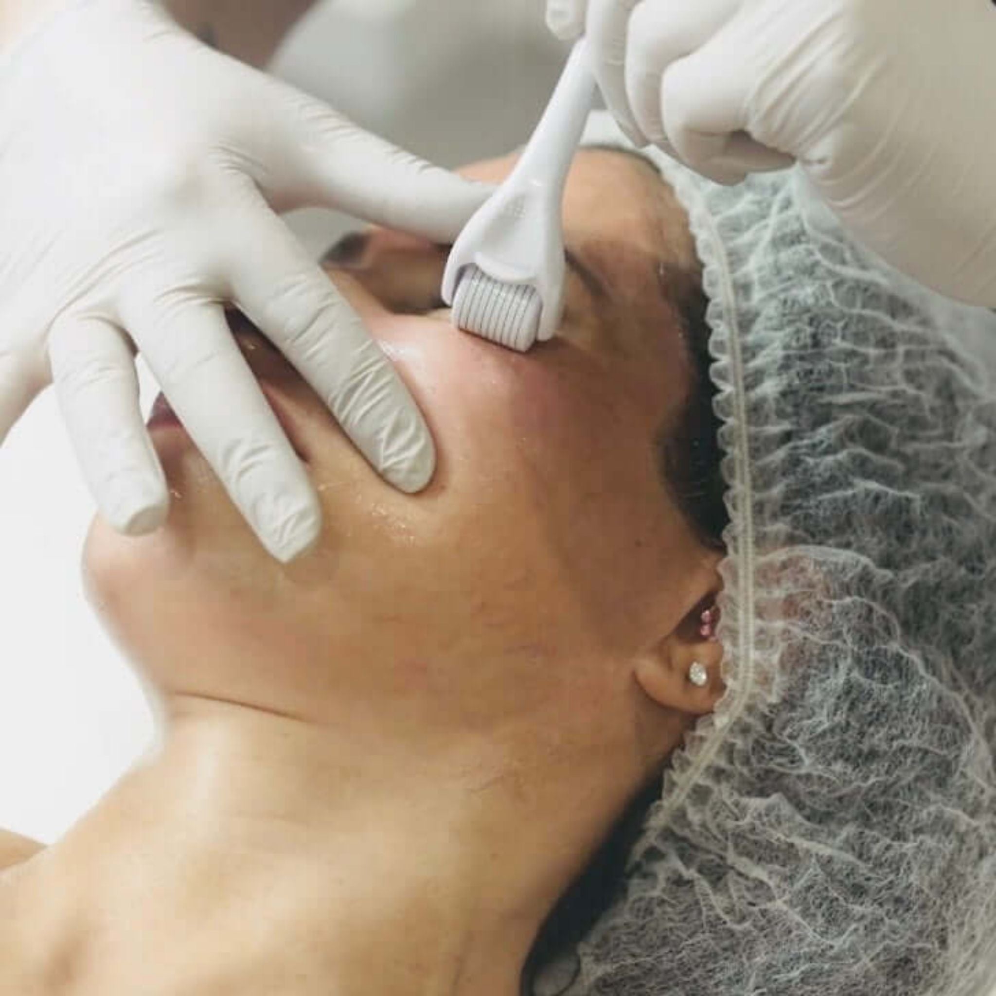 Join a hands-on microneedling training class to master skin rejuvenation techniques for scars and fine lines